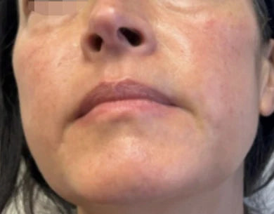 Skin after ION* Skin Support
