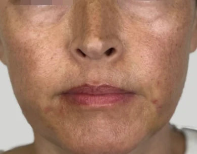 Skin before ION* Skin Support